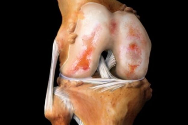 Разрушаване на колянната става поради артроза - често срещана патология на опорно-двигателния апарат