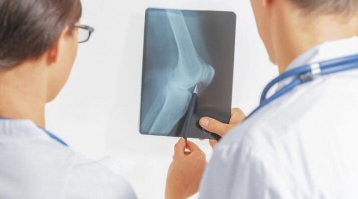 След необходимата диагноза на артрозата на колянната става, лекарите предписват комплексно лечение
