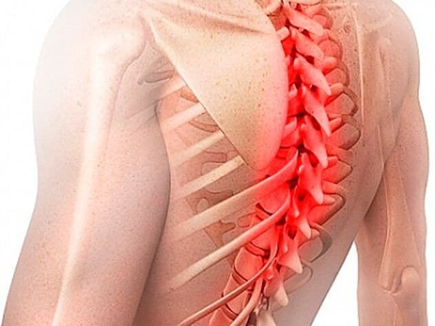 Остеохондрозата на гръдния кош е рядка форма на заболяването