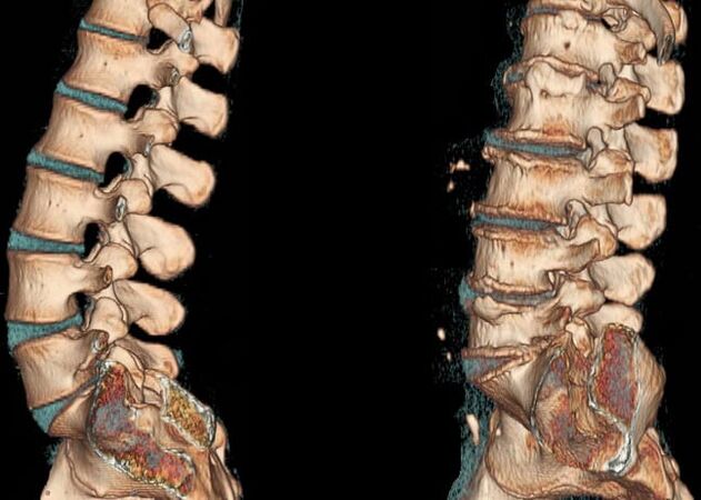 CT сканиране на лумбалния гръбначен стълб при нормални условия и с остеохондроза