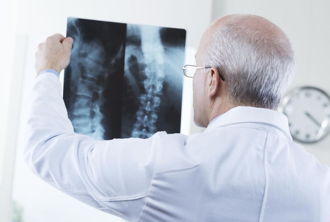 лекарят преглежда моментна снимка на шийния отдел на гръбначния стълб с остеохондроза
