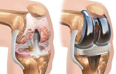 Ендопротезиране на колянна става с гонартроза